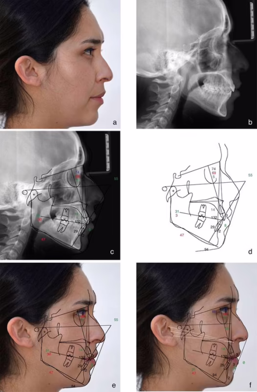¿Qué es el plano de Camper en odontología?